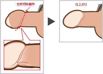 包茎治療 福嶋美容外科クリニック Men S メンズ